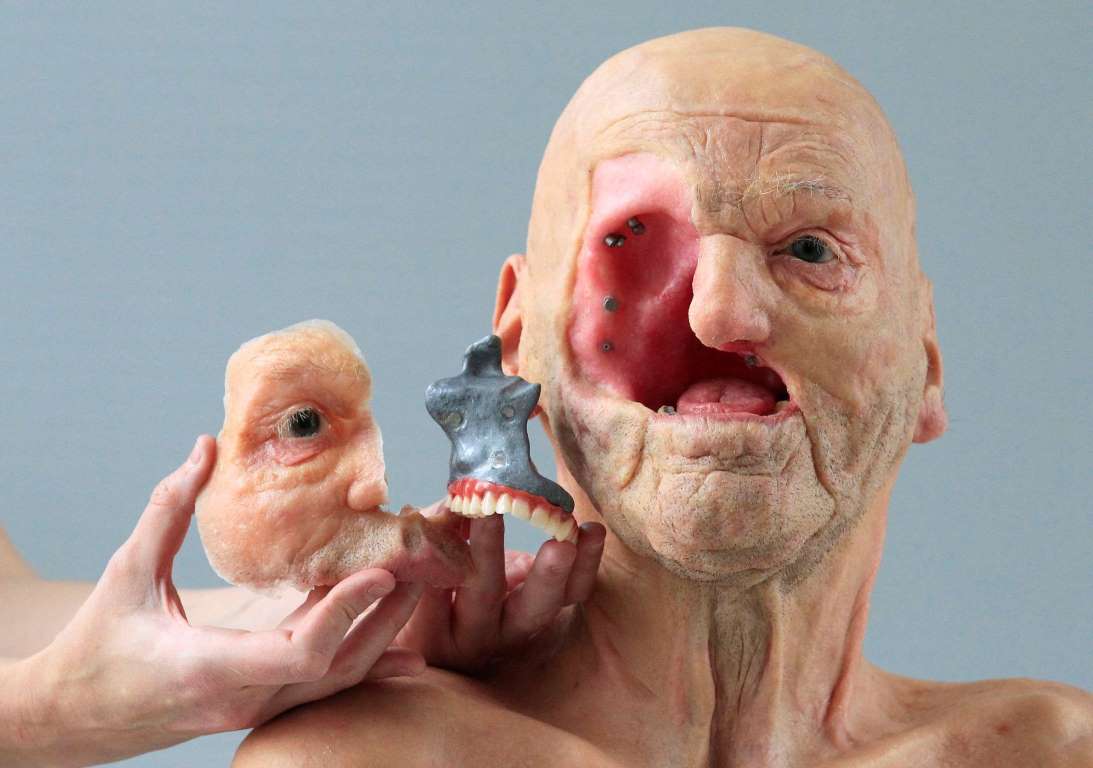 2. Протез лица, напечатанный на 3D-принтере бельгийской компанией Materialise.