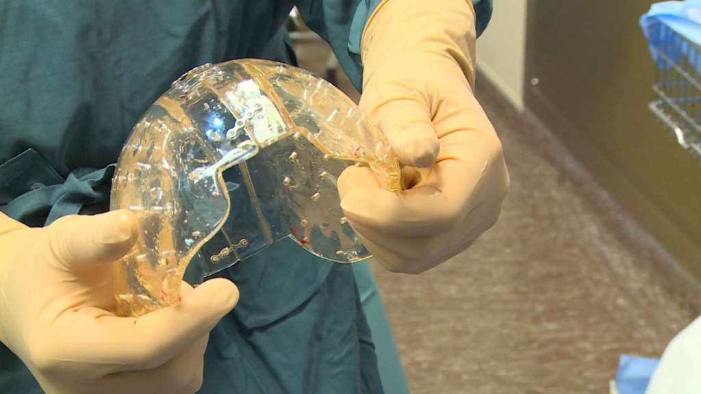 5. Голландские хирурги из UMC Utrecht провели первую в мире операцию по вживлению протеза черепа, напечатанного на 3D-принтере. У их 22-летней пациентки сжимались кости черепа, в результате чего постоянно росло давление на ткани головного мозга. Операция, которая длилась 23 часа, и напечатанный череп спасли ей жизнь. 